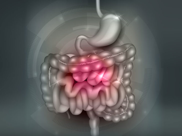 Erfahren Sie hier alles über das Reizdarmsyndrom und Therapieansätze.