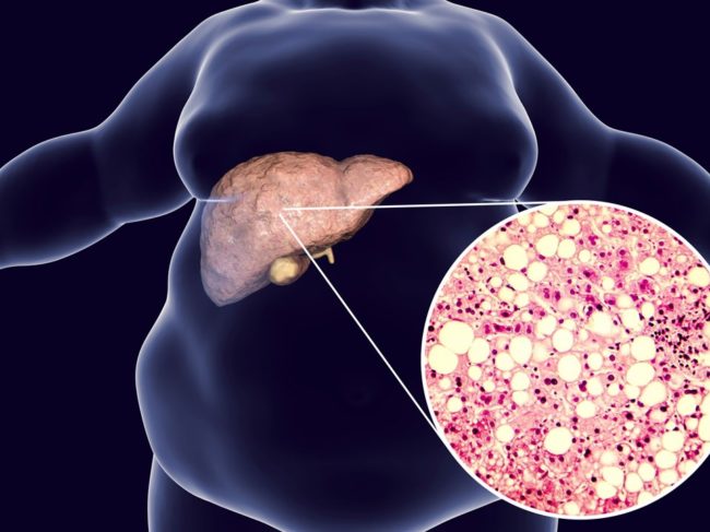 Mit einer Fettleber hat der Stoffwechsel schlechte Karten