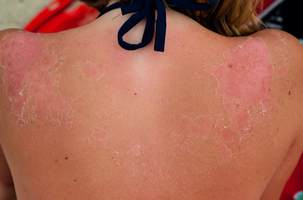 Sonnenbrand kann Psoriasis auslösen.