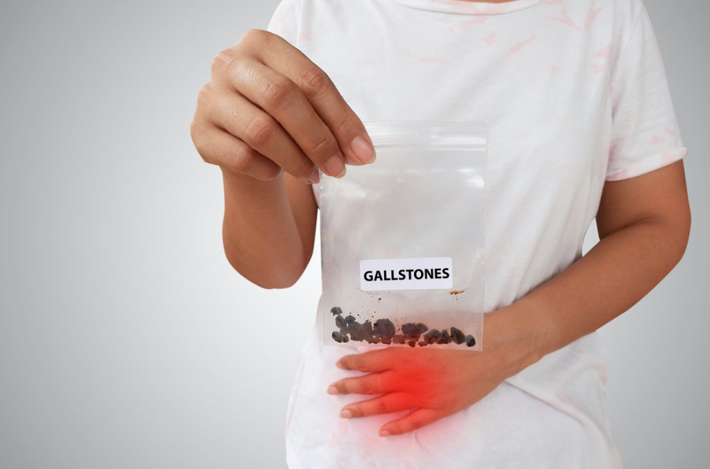 Dadurch, dass auch zu wenig Gallensäuren vom Körper aufgenommen werden (diese sind notwendig, um die aufgenommenen Fette und fettlöslichen Vitamine löslich zu machen und so die Resorption zu erleichtern), steigt beim Kurzdarmsyndrom leider auch das Risiko für Gallensteine. 