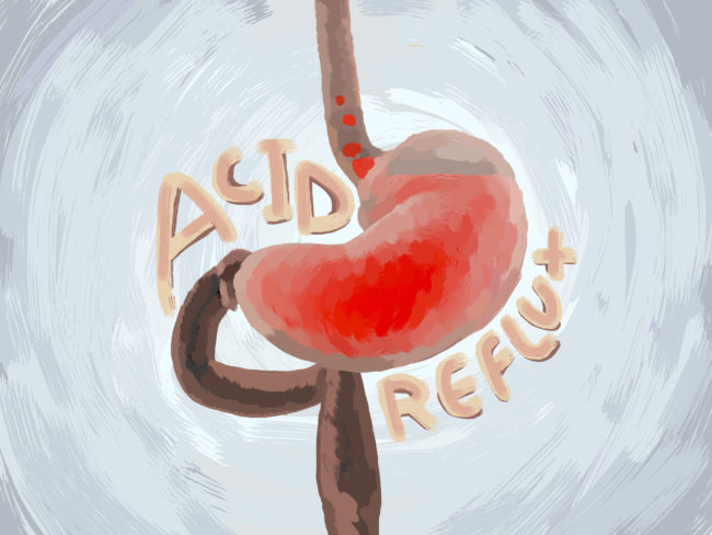 Acid,Reflux,,Gerd.,Gastroesophageal,Reflux,Disease.,Stomach,And,Digestive.,Human
